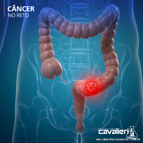 Como é o sangramento de quem tem câncer no reto? Entenda os sinais e cuidados