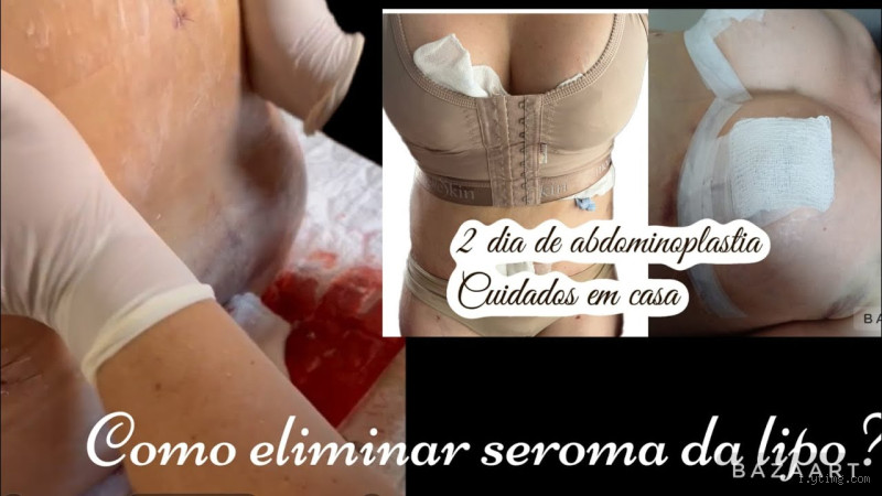 Como evitar seroma Na abdominoplastia?