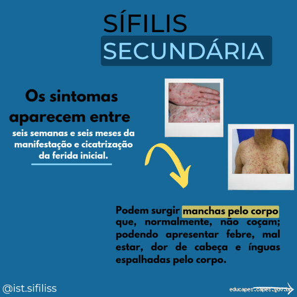 Como é a ferida da sífilis? Entenda os sinais e sintomas