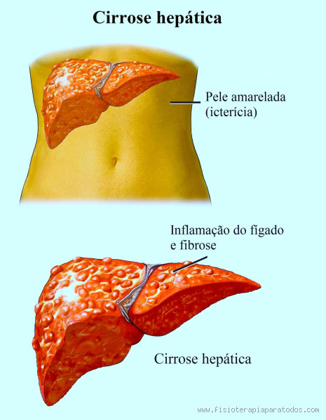 Como Reconhecer Dor no Fígado? Sintomas e Causas Essenciais que Você Não Pode Ignorar!