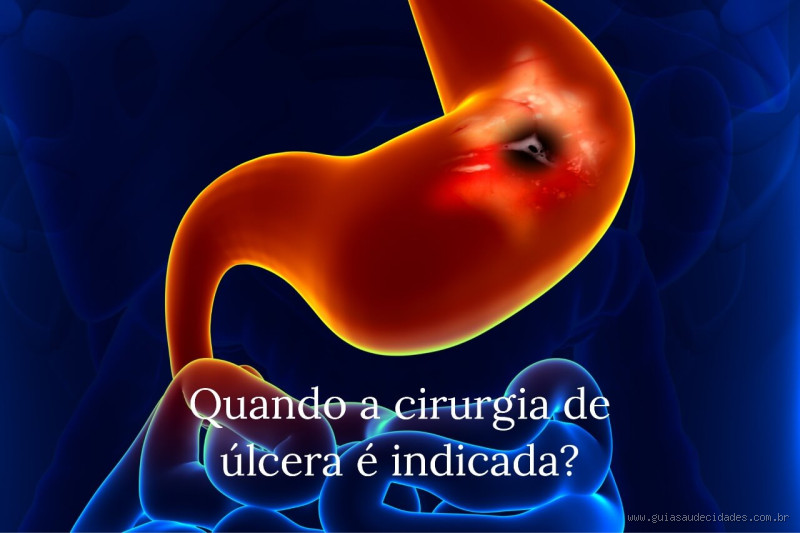 Como se chama a cirurgia de úlcera? Entenda o tratamento necessário