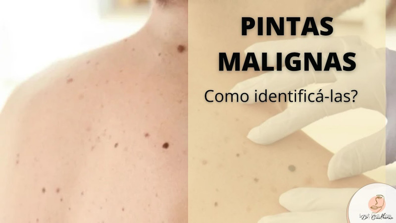 O Que Acontece se a Pinta for Maligna? Descubra os Riscos