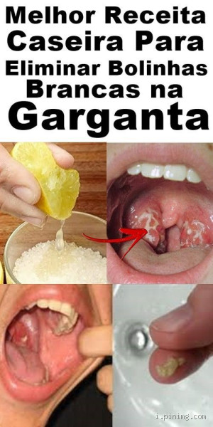 O que fazer para evitar bolinhas brancas na garganta? Dicas essenciais!