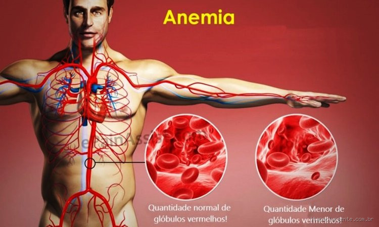 O que leva a pessoa a ter anemia? Entenda as causas e como prevenir