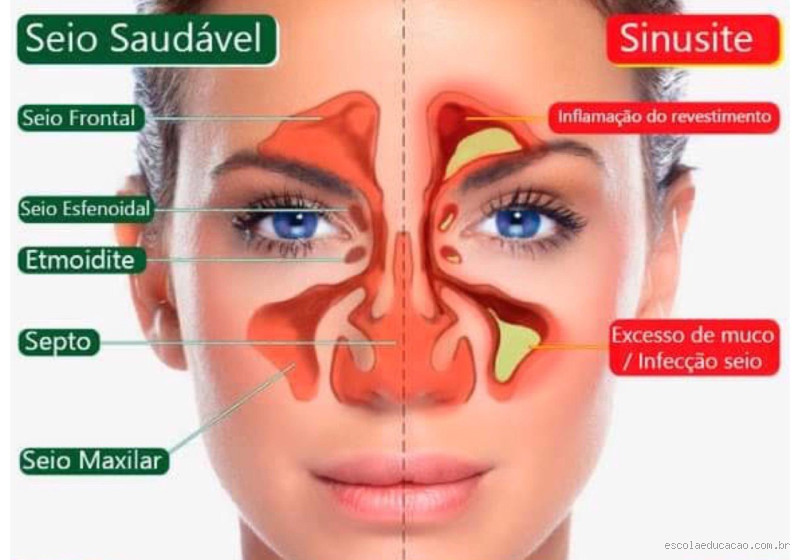 Onde a sinusite ataca? Descubra os locais mais afetados