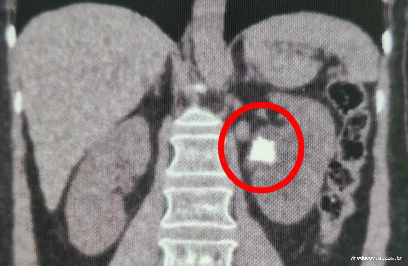 Qual Exame de Sangue Detecta Pedra nos Rins?