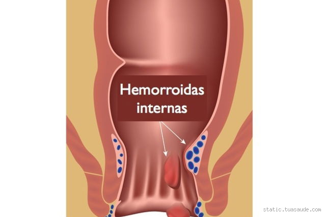 Qual o tamanho de uma hemorroida? Descubra as variações e o que esperar