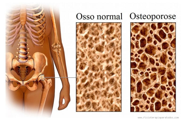 Quando a osteoporose se torna grave?