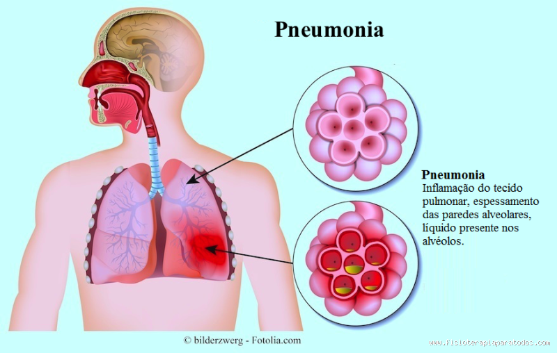 Quando o catarro pode virar pneumonia? Entenda os riscos e sintomas