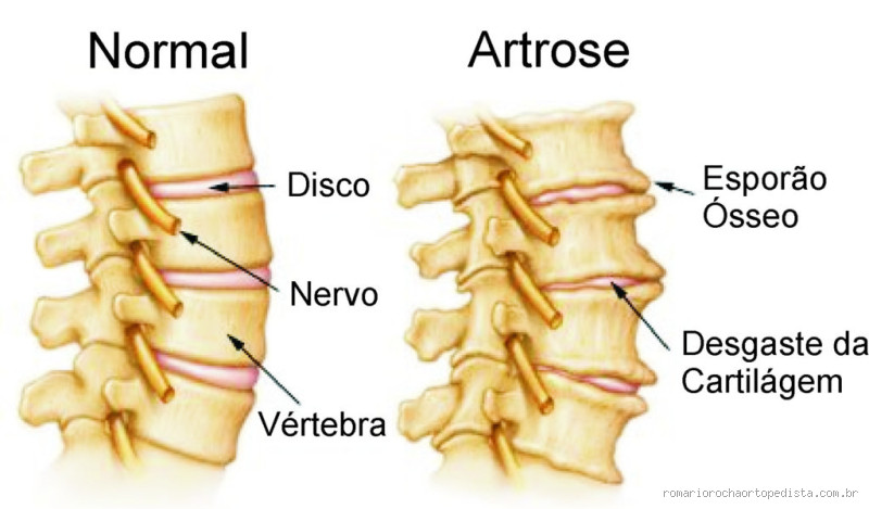 Quem tem artrose na coluna tem direito ao benefício?
