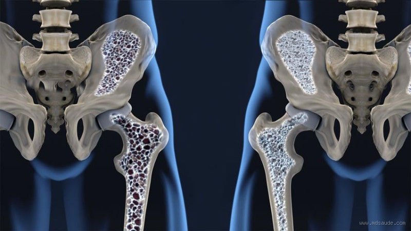 Quem tem osteoporose pode ter uma vida normal?