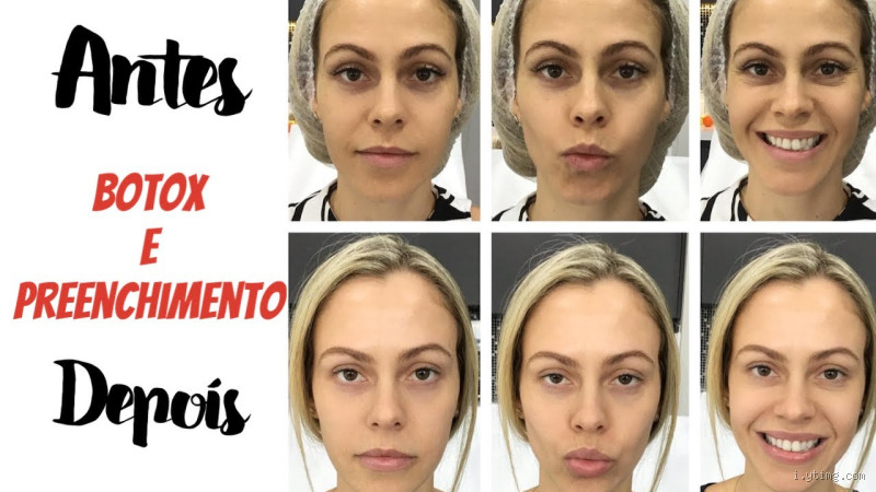 Como fica o rosto depois que sai o botox? Descubra o que realmente acontece