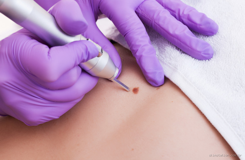 Como tirar um sinal sem cirurgia? Métodos alternativos para remoção