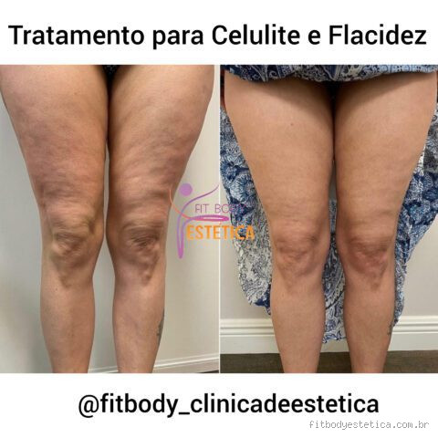 Qual o melhor remédio para celulite e flacidez? Veja o que realmente funciona
